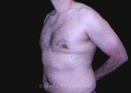 Gynecomastia Before & After Patient #10187