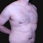 Gynecomastia Before & After Patient #10187
