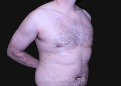 Gynecomastia Before & After Patient #10187