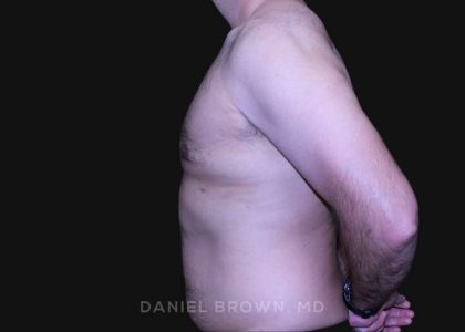 Gynecomastia Before & After Patient #10187