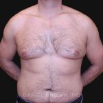 Gynecomastia Before & After Patient #10187