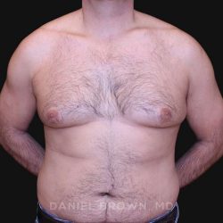 Gynecomastia Before & After Patient #10187