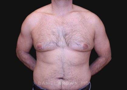 Gynecomastia Before & After Patient #10187