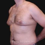 Gynecomastia Before & After Patient #10187