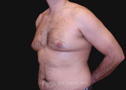 Gynecomastia Before & After Patient #10187