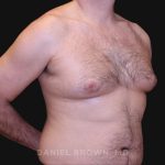 Gynecomastia Before & After Patient #10187