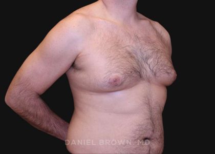 Gynecomastia Before & After Patient #10187
