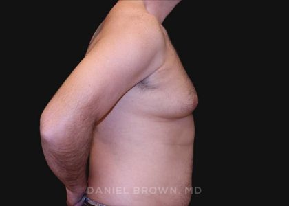 Gynecomastia Before & After Patient #10187