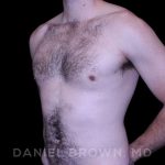 Gynecomastia Before & After Patient #10200