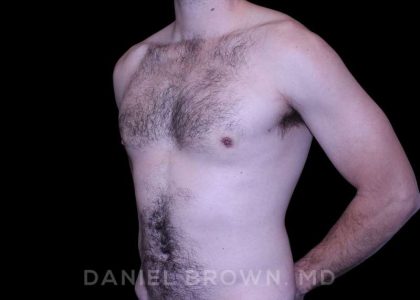 Gynecomastia Before & After Patient #10200