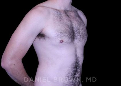 Gynecomastia Before & After Patient #10200