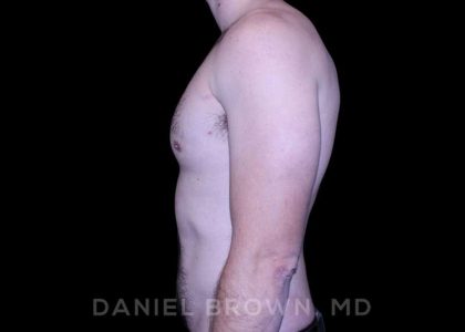 Gynecomastia Before & After Patient #10200
