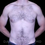 Gynecomastia Before & After Patient #10200