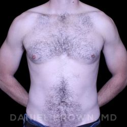 Gynecomastia Before & After Patient #10200