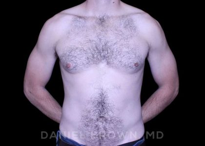 Gynecomastia Before & After Patient #10200