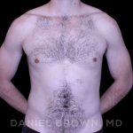 Gynecomastia Before & After Patient #10200