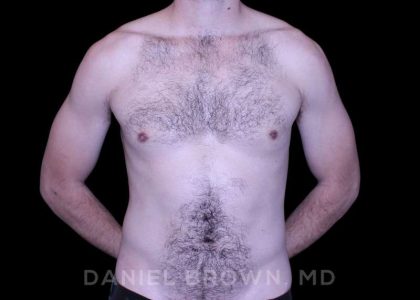 Gynecomastia Before & After Patient #10200