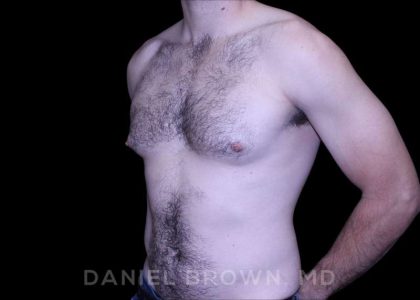 Gynecomastia Before & After Patient #10200