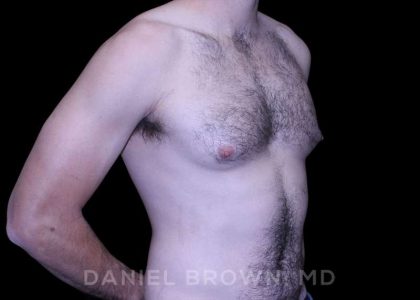 Gynecomastia Before & After Patient #10200