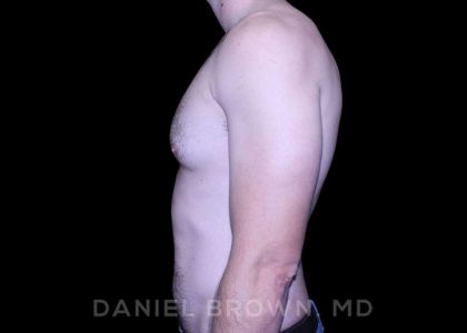 Gynecomastia Before & After Patient #10200