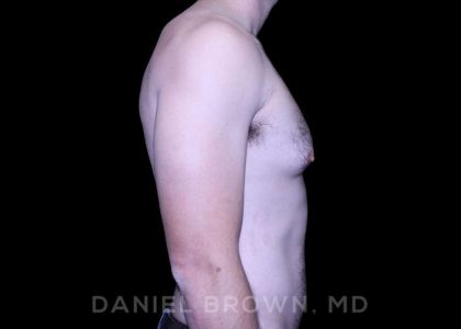 Gynecomastia Before & After Patient #10200