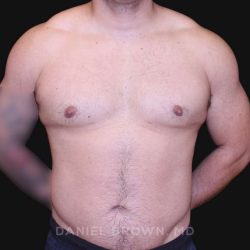 Gynecomastia Before & After Patient #10211