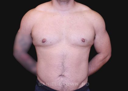 Gynecomastia Before & After Patient #10211