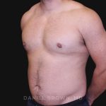 Gynecomastia Before & After Patient #10211