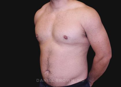 Gynecomastia Before & After Patient #10211
