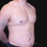 Gynecomastia Before & After Patient #10211