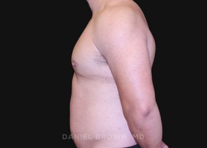 Gynecomastia Before & After Patient #10211