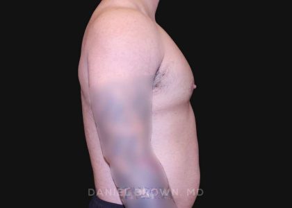 Gynecomastia Before & After Patient #10211