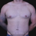 Gynecomastia Before & After Patient #10211