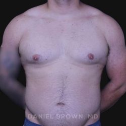 Gynecomastia Before & After Patient #10211