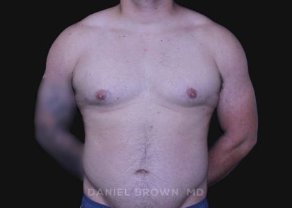 Gynecomastia Before & After Patient #10211