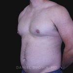 Gynecomastia Before & After Patient #10211