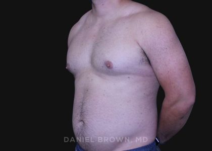 Gynecomastia Before & After Patient #10211