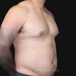 Gynecomastia Before & After Patient #10211