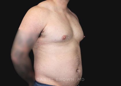 Gynecomastia Before & After Patient #10211