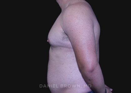 Gynecomastia Before & After Patient #10211