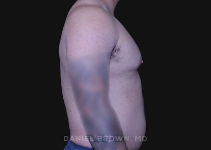Gynecomastia Before & After Patient #10211