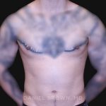 Gynecomastia Before & After Patient #10222