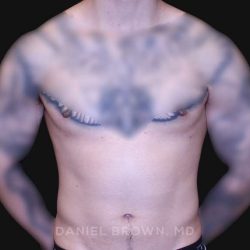 Gynecomastia Before & After Patient #10222