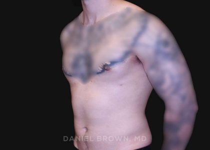 Gynecomastia Before & After Patient #10222