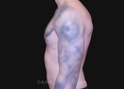 Gynecomastia Before & After Patient #10222