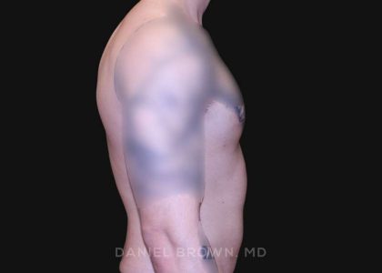 Gynecomastia Before & After Patient #10222