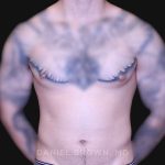 Gynecomastia Before & After Patient #10222