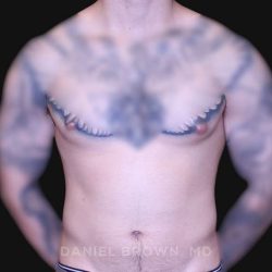 Gynecomastia Before & After Patient #10222