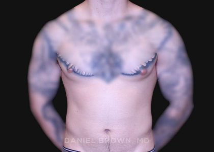 Gynecomastia Before & After Patient #10222