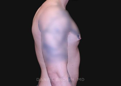 Gynecomastia Before & After Patient #10222